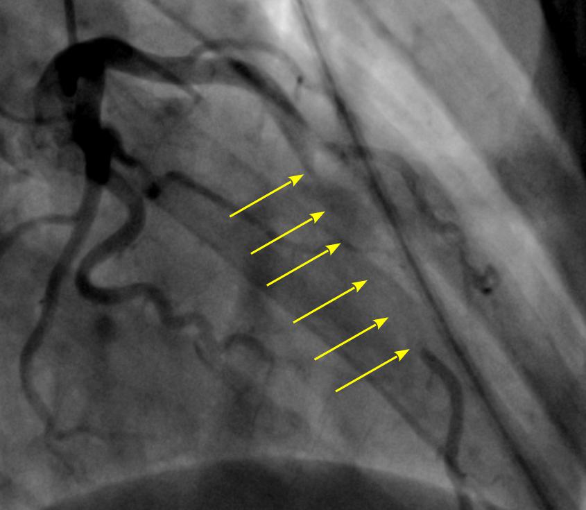 супракоронарная миотомия у ребенка-3