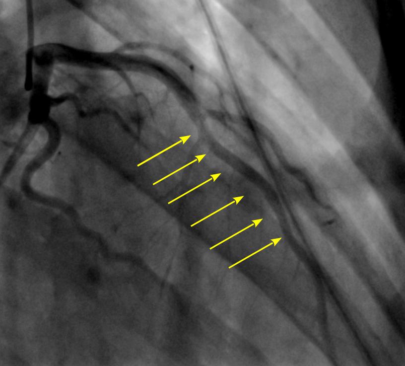супракоронарная миотомия у ребенка-4