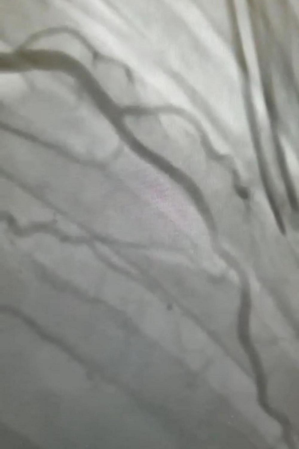 супракоронарная миотомия у ребенка-5_0