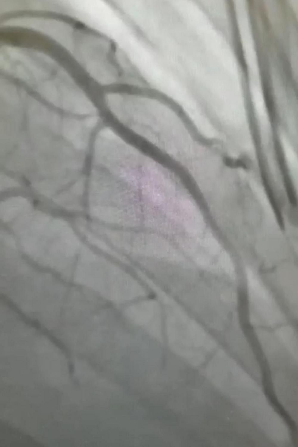 супракоронарная миотомия у ребенка-6_0