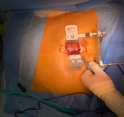 супракоронарная миотомия у ребенка-7