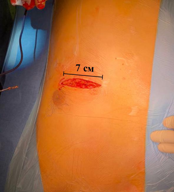 супракоронарная миотомия у ребенка-8