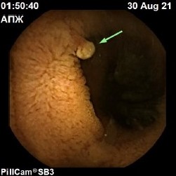 эпителиальная неоплазия_0